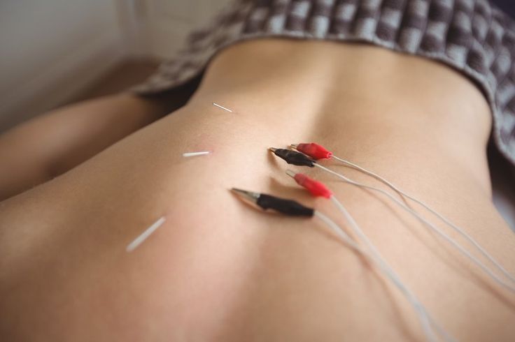 Dry Needling & Electrotherapy Electro needling